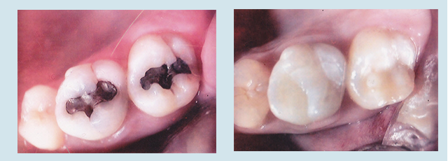 dental-fillings-marco-island-2