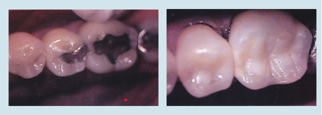 dental-fillings-marco-island-3
