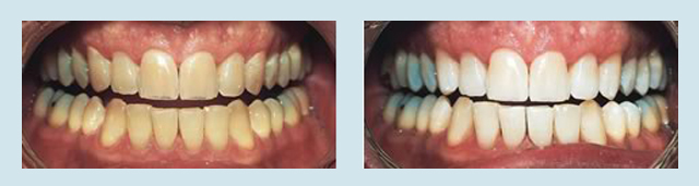 Marco Island teeth whitening